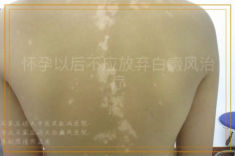怀孕以后不应放弃白癜风治疗