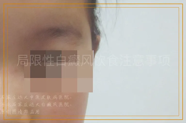 局限性白癜风饮食注意事项