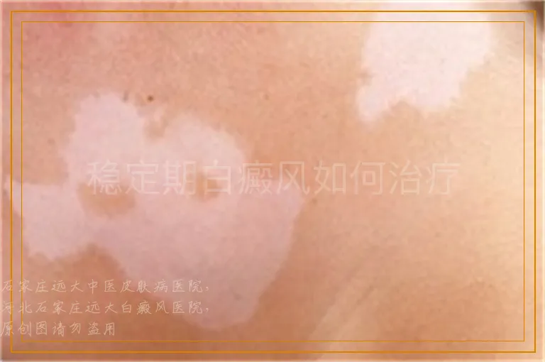 稳定期白癜风如何治疗