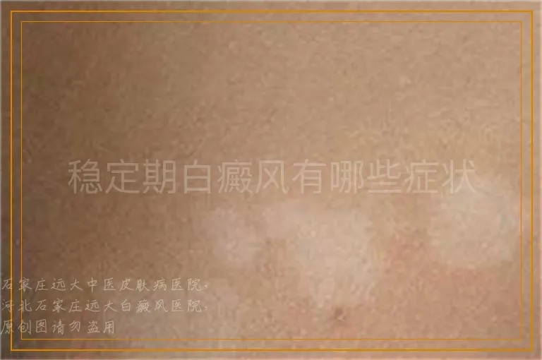 稳定期白癜风有哪些症状