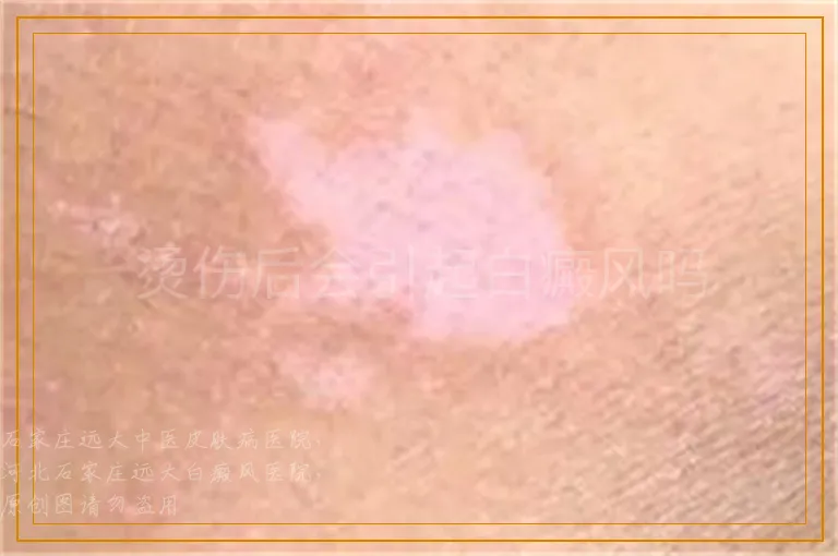 烫伤后会引起白癜风吗