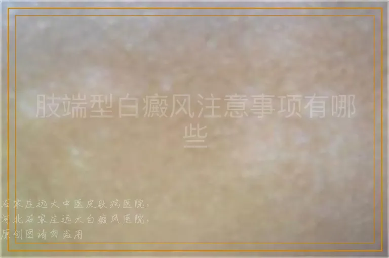 肢端型白癜风注意事项有哪些