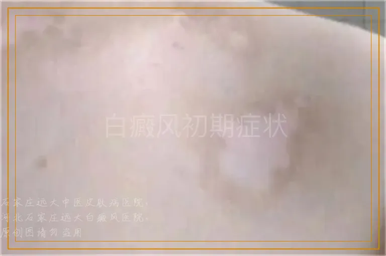 白癜风初期症状