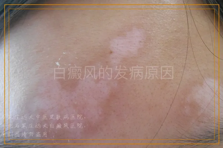 白癜风的发病原因