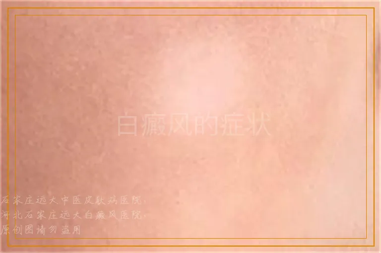 白癜风的症状