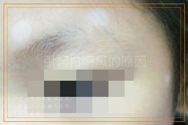 引起白癜风的原因