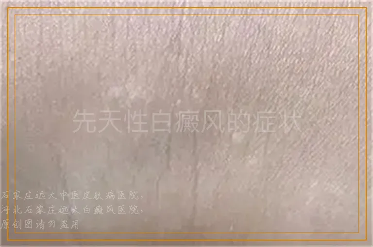 先天性白癜风的症状