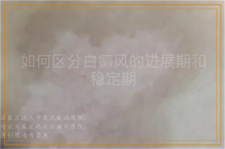 如何区分白癜风的进展期和稳定期
