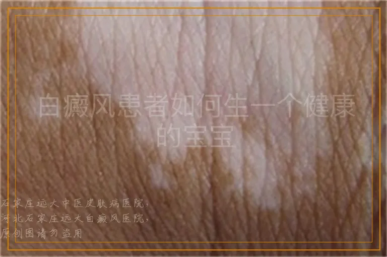 白癜风患者如何生一个健康的宝宝