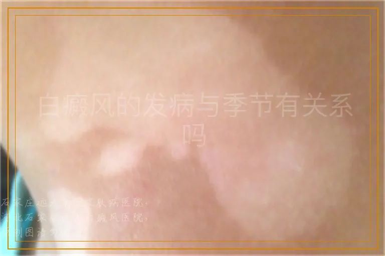 白癜风的发病与季节有关系吗
