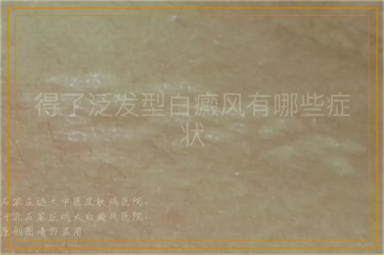 得了泛发型白癜风有哪些症状