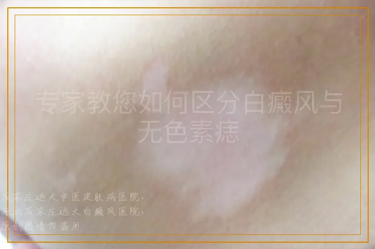 专家教您如何区分白癜风与无色素痣