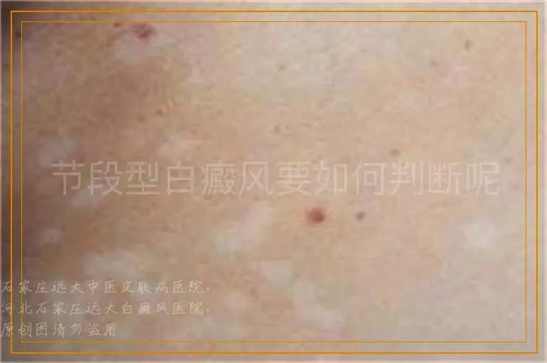 节段型白癜风要如何判断呢