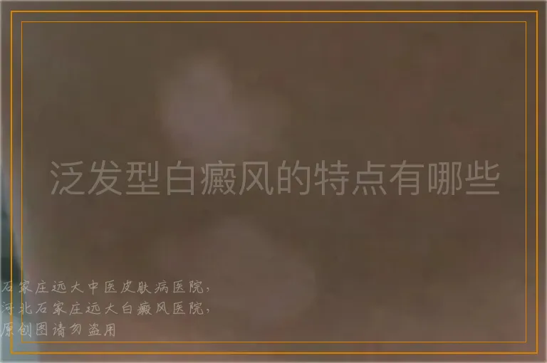 泛发型白癜风的特点有哪些