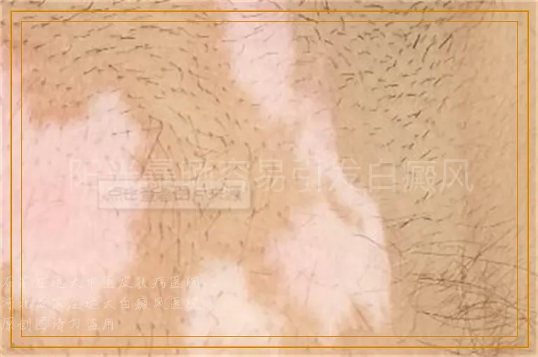 阳光暴晒容易引发白癜风