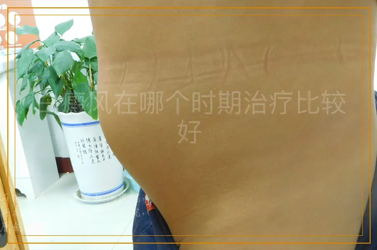白癜风在哪个时期治疗比较好