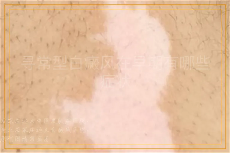 寻常型白癜风在早期有哪些症状