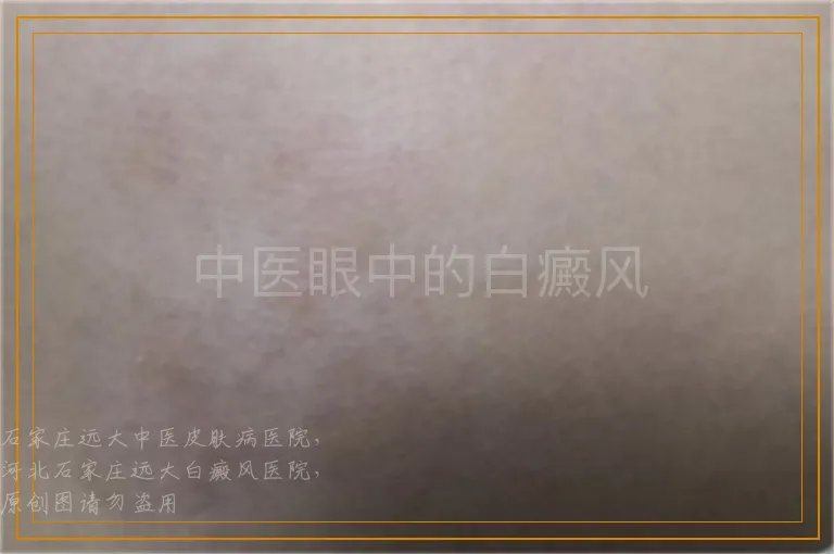 中医眼中的白癜风