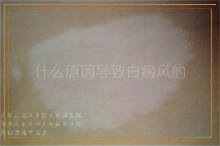 什么原因导致白癜风的