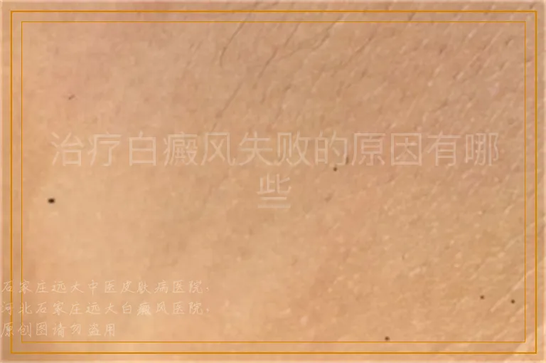 治疗白癜风失败的原因有哪些