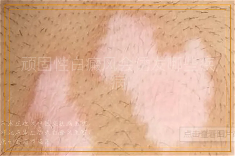 顽固性白癜风会诱发哪些疾病