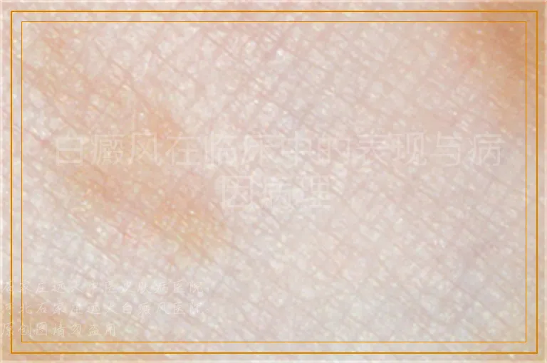 白癜风在临床中的表现与病因病理