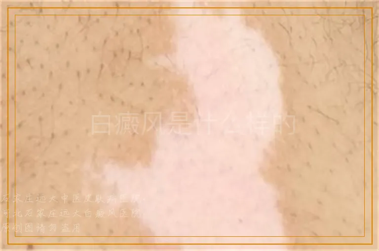 白癜风是什么样的