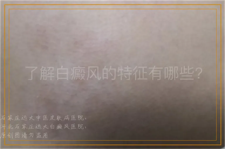 了解白癜风的特征有哪些?