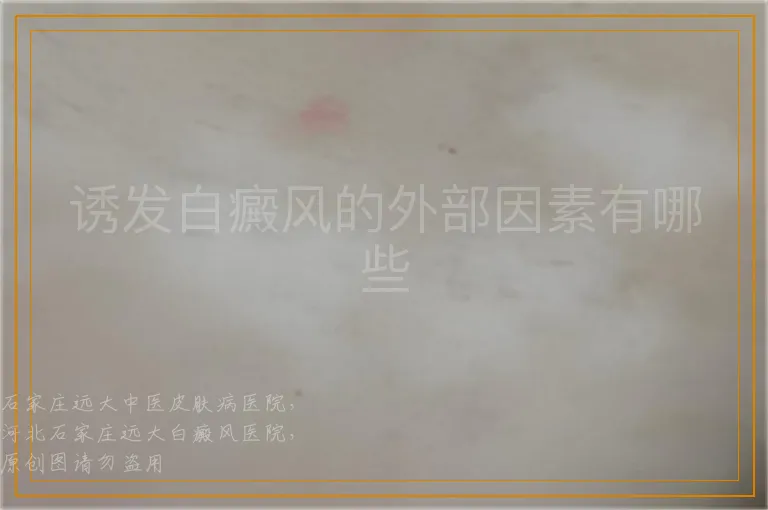 诱发白癜风的外部因素有哪些