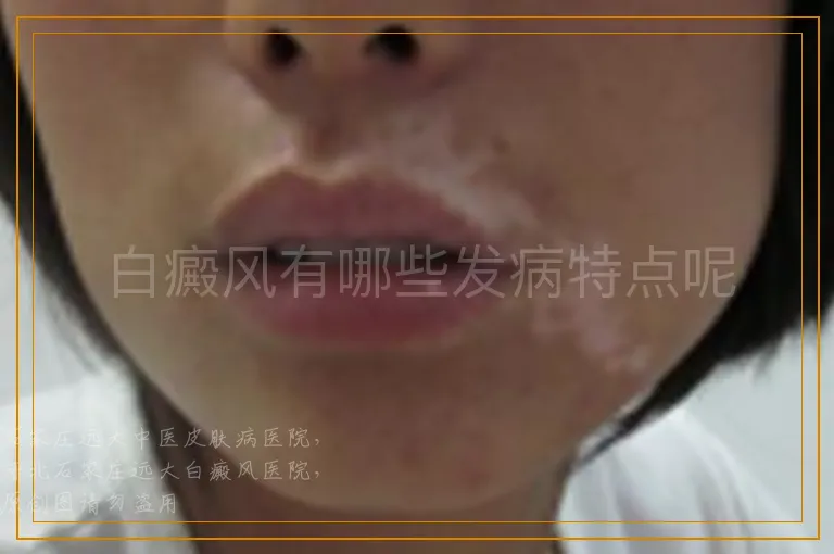 白癜风有哪些发病特点呢