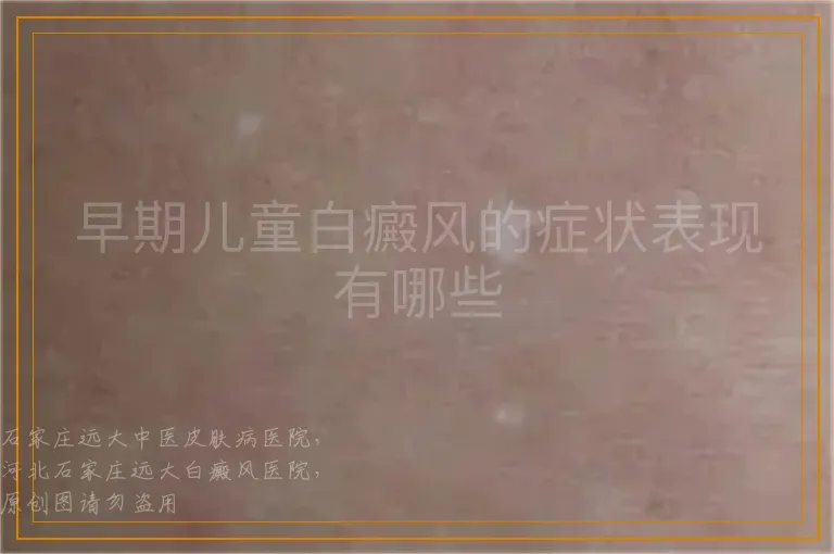 早期儿童白癜风的症状表现有哪些