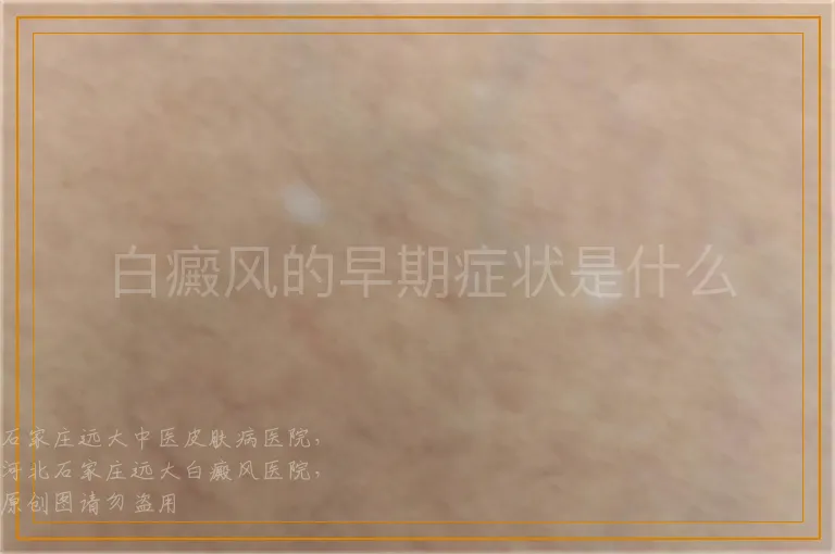 白癜风的早期症状是什么