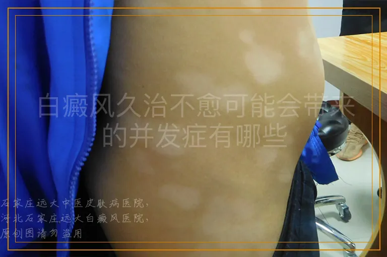 白癜风久治不愈可能会带来的并发症有哪些