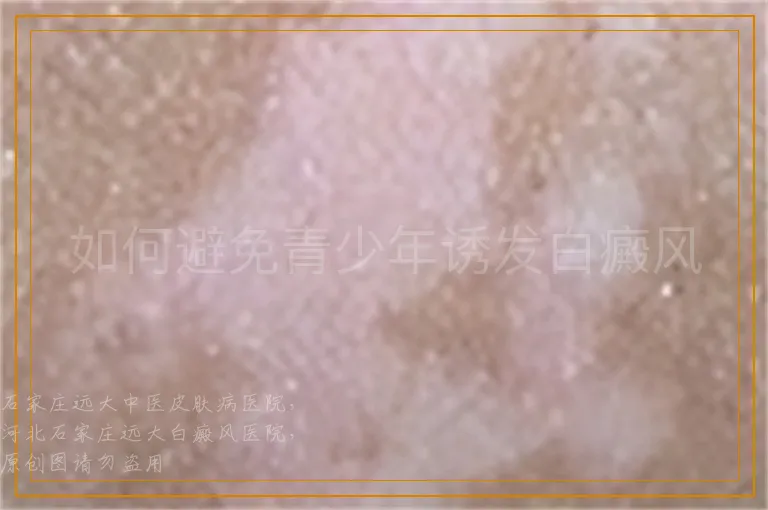 如何避免青少年诱发白癜风