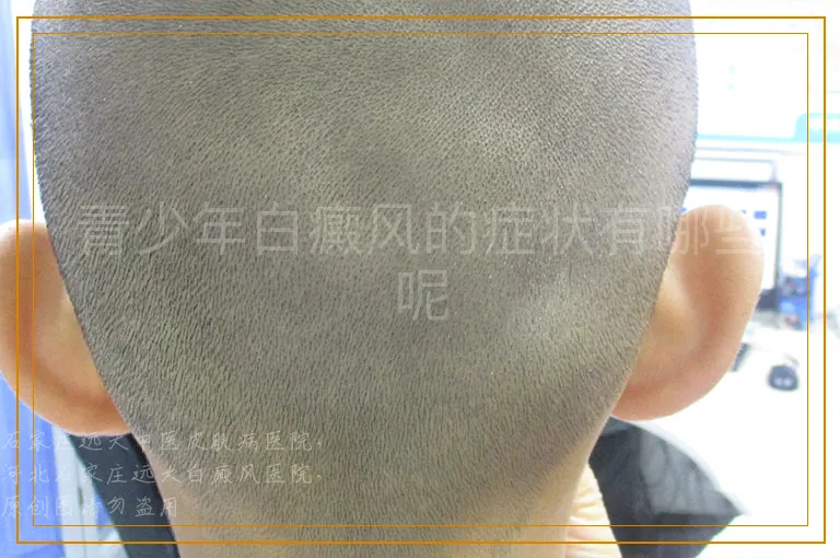 青少年白癜风的症状有哪些呢