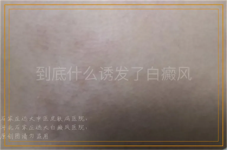 到底什么诱发了白癜风
