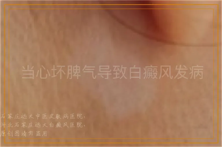当心坏脾气导致白癜风发病