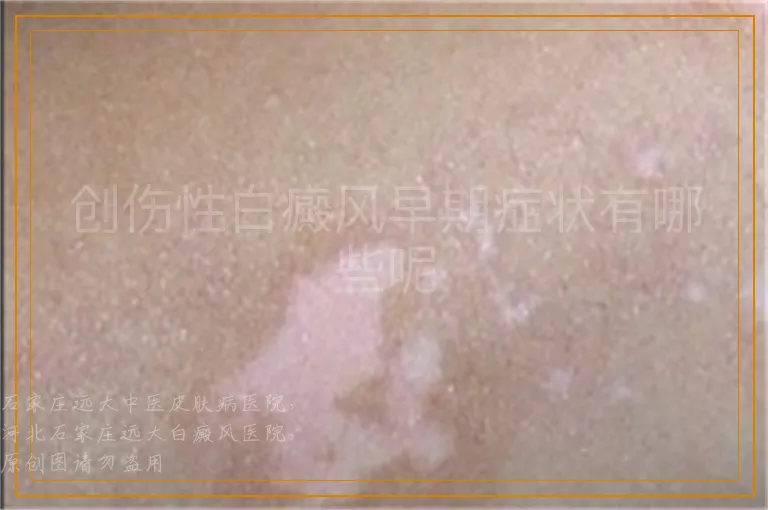 创伤性白癜风早期症状有哪些呢