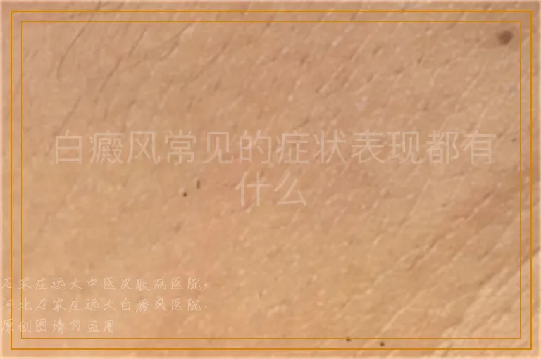 白癜风常见的症状表现都有什么