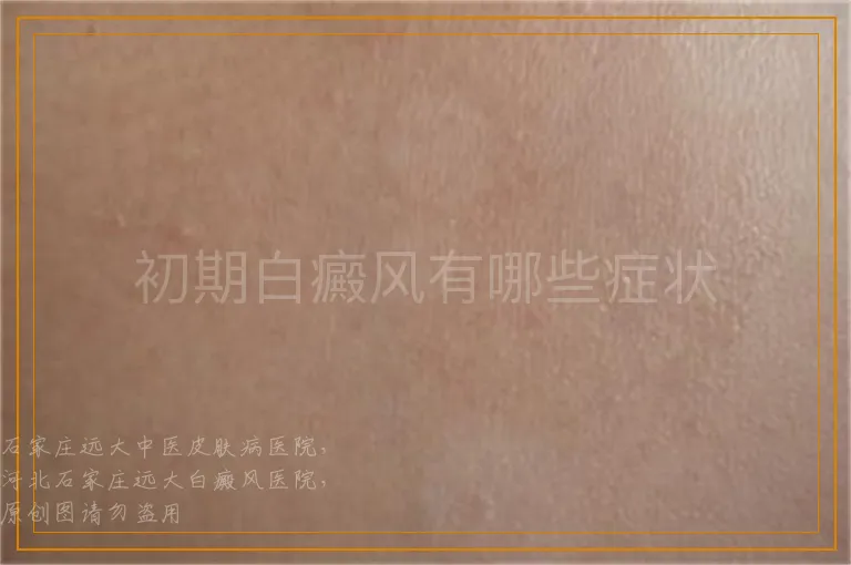 初期白癜风有哪些症状