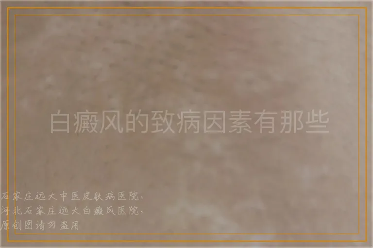 白癜风的致病因素有那些