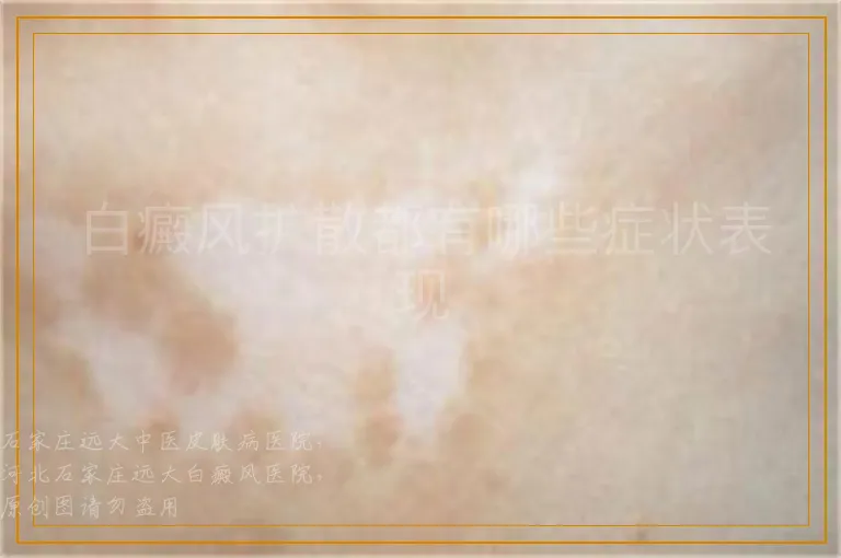 白癜风扩散都有哪些症状表现