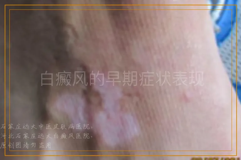 白癜风的早期症状表现