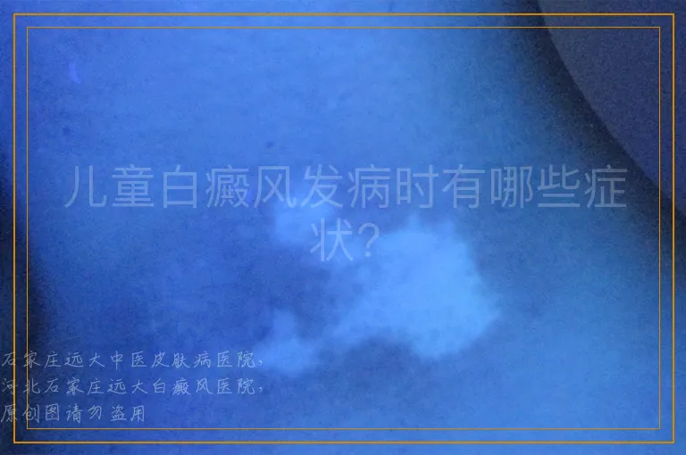 儿童白癜风发病时有哪些症状?