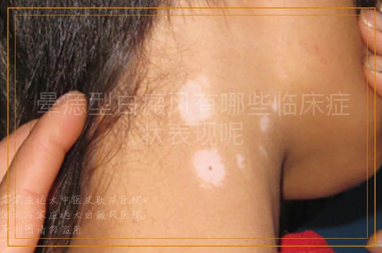 晕痣型白癜风有哪些临床症状表现呢