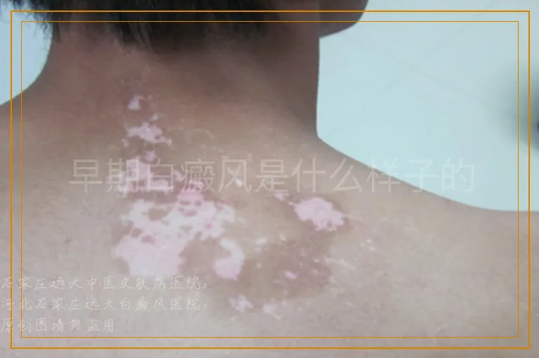 早期白癜风是什么样子的