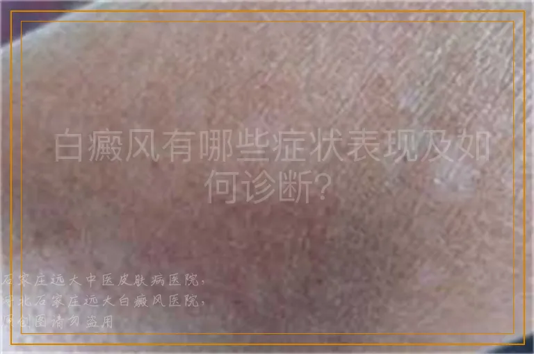 白癜风有哪些症状表现及如何诊断？