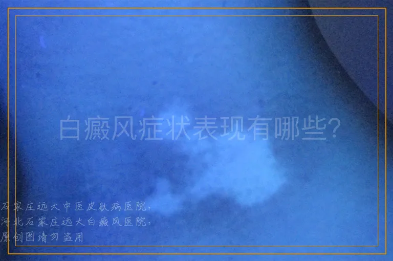 白癜风症状表现有哪些？