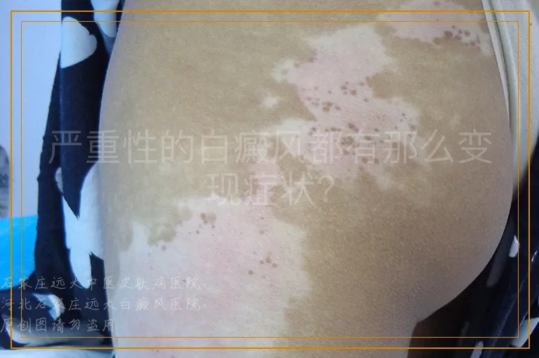 严重性的白癜风都有那么变现症状？