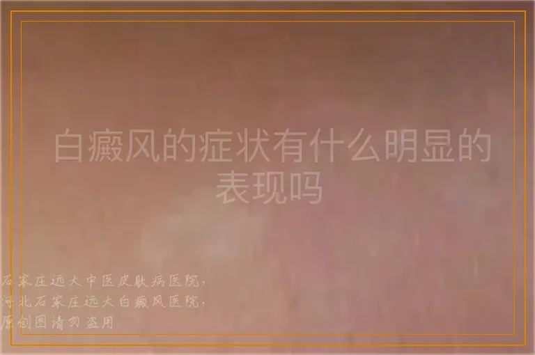 白癜风的症状有什么明显的表现吗